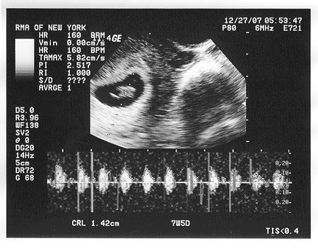 dating ultrasound no heartbeat